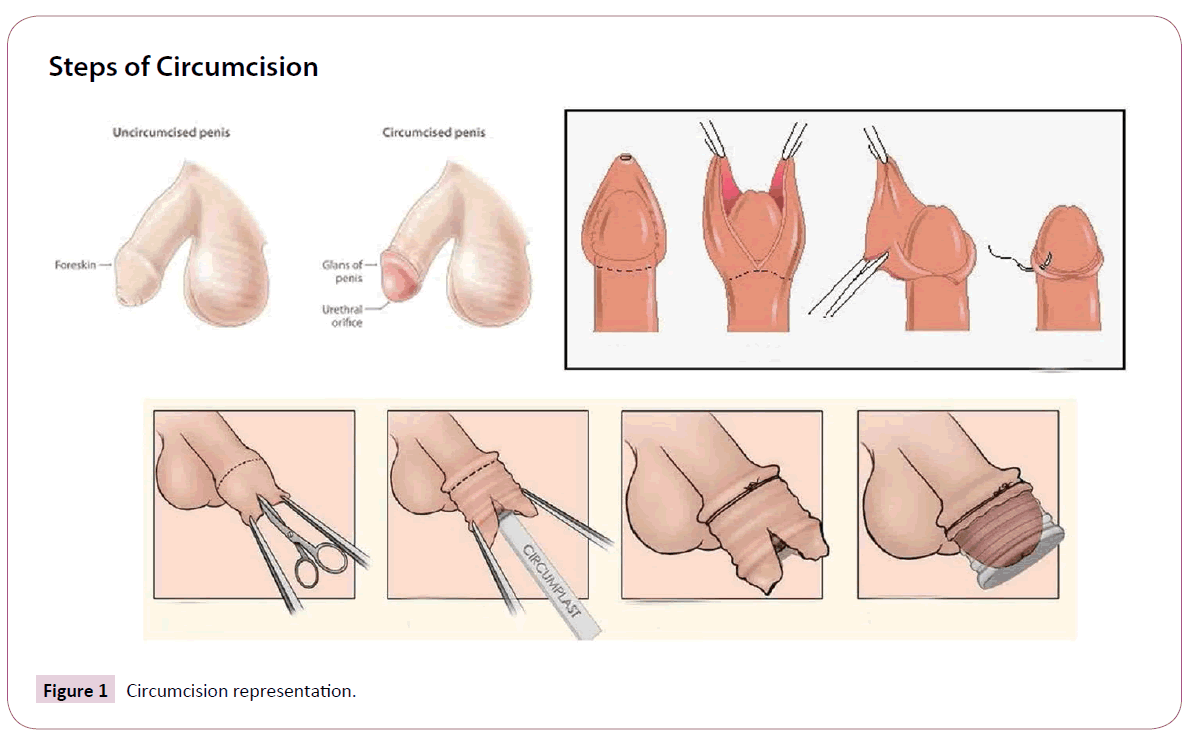 Picture Of A Circumcised Penis