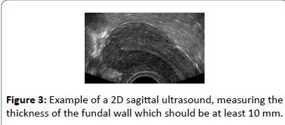 contraceptivestudies-2D-sagittal-ultrasound