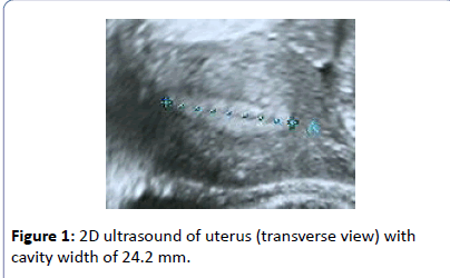 contraceptivestudies-2D-ultrasound