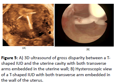 paragard iud ultrasound