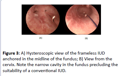 contraceptivestudies-narrow-cavity